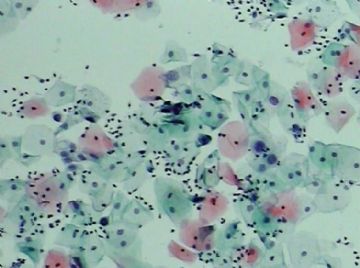 宫颈TCT（19）-组织学图片已上传图11