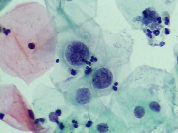 宫颈TCT（19）-组织学图片已上传图12