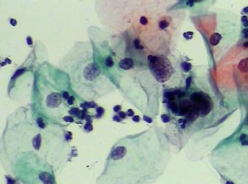 宫颈TCT（19）-组织学图片已上传图16