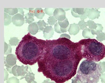 女 84岁 胸水 有胸骨骨折 是癌细胞 还是间皮细胞增生+PAS 染色图14