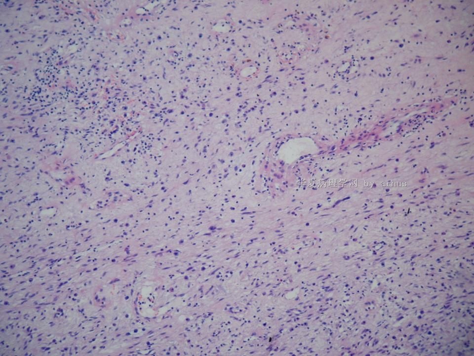 右侧腹股沟肿物-452554图5