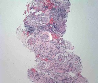 Young adult with elevated creatinine图2