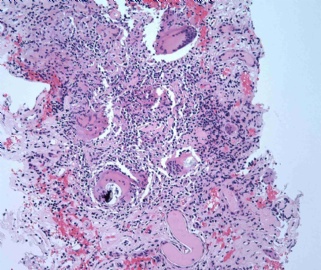 Young adult with elevated creatinine图3