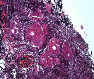 Young adult with elevated creatinine图10