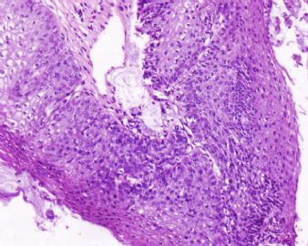 宫颈液基会诊,上传组织学图11