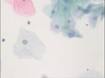 TCT441,39岁，宫颈糜烂II°，宫颈口2点处赘生物，图3