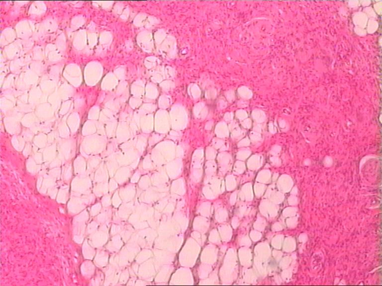是梭形细胞脂肪瘤吗？图9