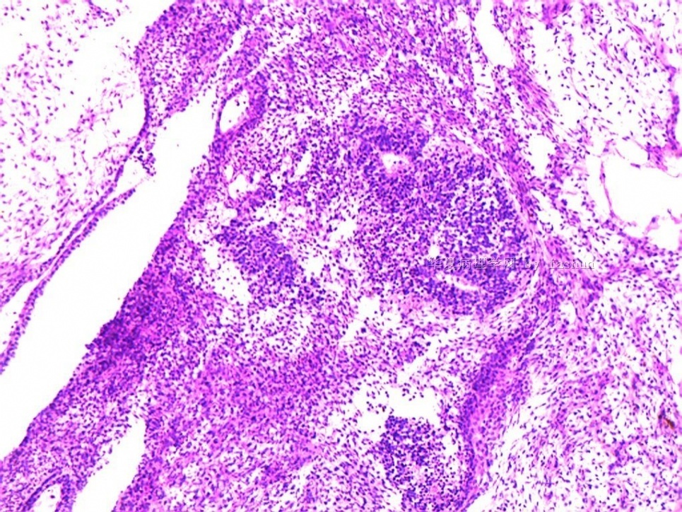 畸胎瘤病理图片