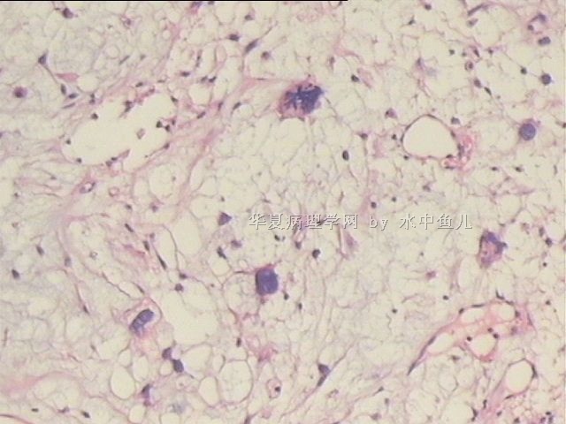 左大腿中段软组织肿块图5