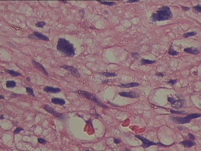 左大腿中段软组织肿块图8