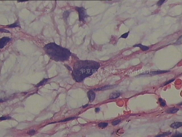 左大腿中段软组织肿块图11