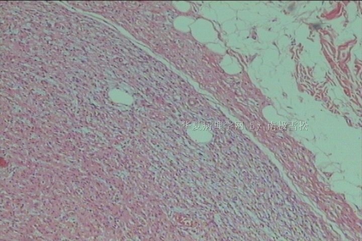 腹股沟区多发性皮肤赘生物图2