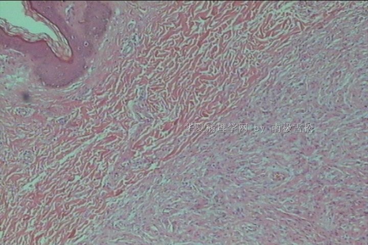 腹股沟区多发性皮肤赘生物图3