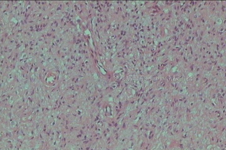 腹股沟区多发性皮肤赘生物图6