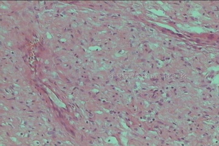 腹股沟区多发性皮肤赘生物图9