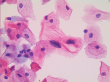 24岁，宫颈液基，H-E染色，轻度糜烂。图6