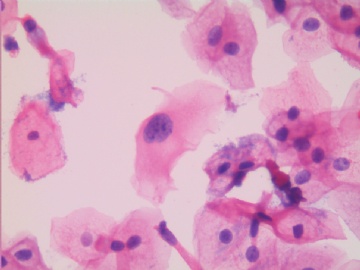24岁，宫颈液基，H-E染色，轻度糜烂。图10