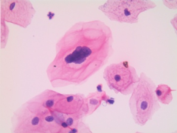 24岁，宫颈液基，H-E染色，轻度糜烂。图17