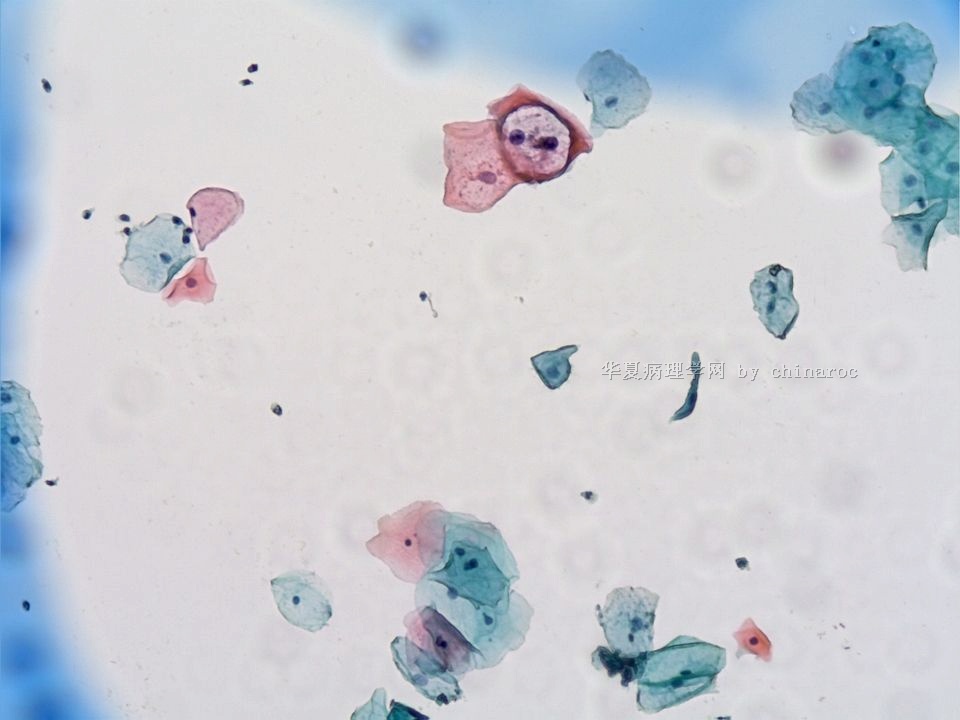 宫颈液基细胞学-地坛11图1