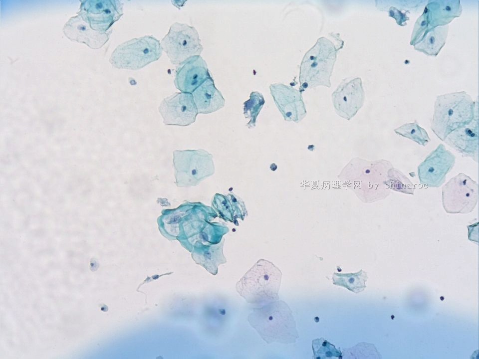 宫颈液基细胞学-地坛11图4