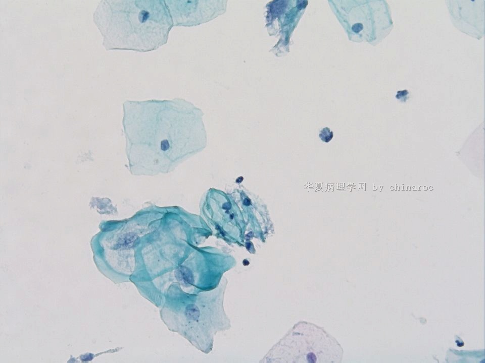 宫颈液基细胞学-地坛11图5