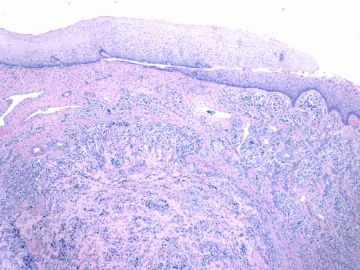 about 40y-f cervical lesion (cqz-G12)图1