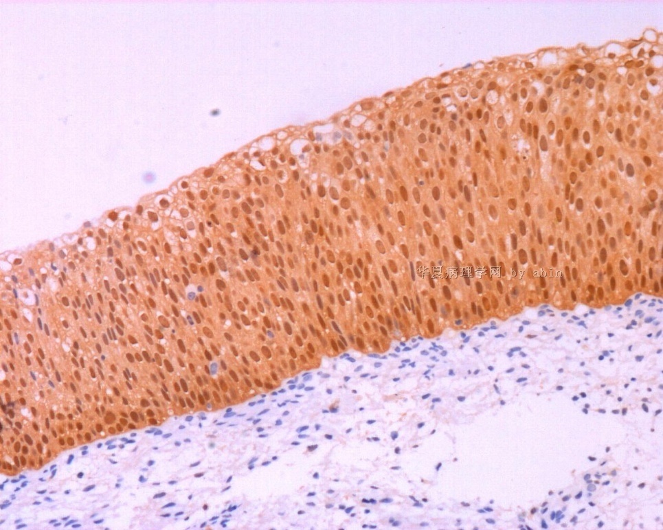 宫颈CIN的p16和Ki67图7