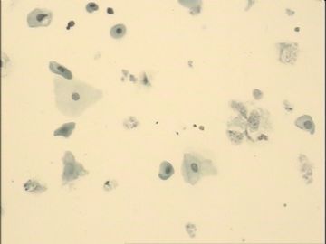 TCT，70岁，近2月阴道点滴出血，宫颈充血，阴道充血，触之出血。图3