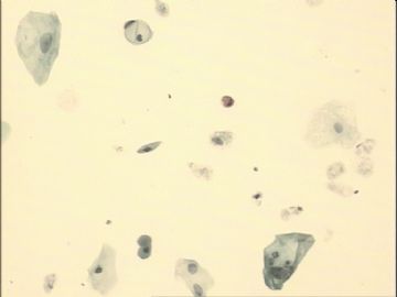 TCT，70岁，近2月阴道点滴出血，宫颈充血，阴道充血，触之出血。图28