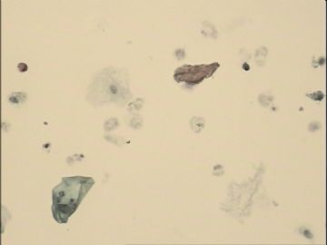 TCT，70岁，近2月阴道点滴出血，宫颈充血，阴道充血，触之出血。图29