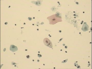 TCT，70岁，近2月阴道点滴出血，宫颈充血，阴道充血，触之出血。图40