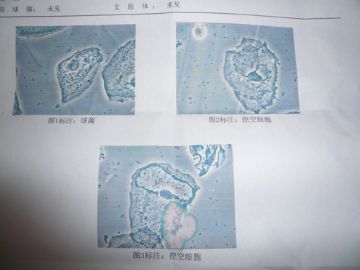 求 解答 阴道分泌物高倍镜检查 挖空细胞图1