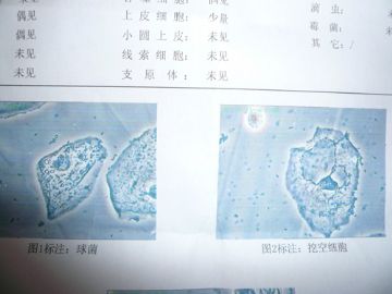 求 解答 阴道分泌物高倍镜检查 挖空细胞图2