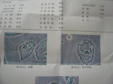 求 解答 阴道分泌物高倍镜检查 挖空细胞图3