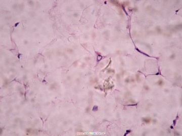 脂肪瘤中的细胞图4