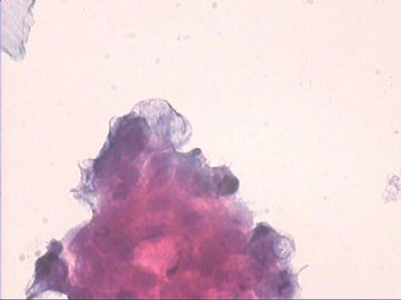 女，41岁宫颈轻糜，宫腔厚6MM，卵巢有小的低回声区。请指教！图11