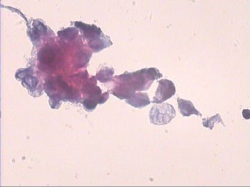 女，41岁宫颈轻糜，宫腔厚6MM，卵巢有小的低回声区。请指教！图12