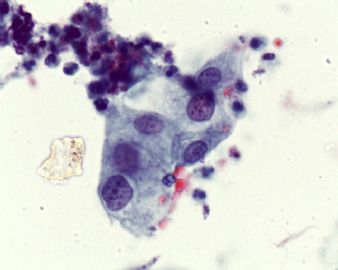 宫颈液基(有组织学）图4
