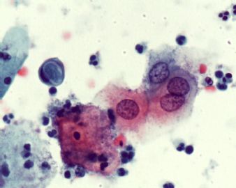 宫颈液基(有组织学）图6