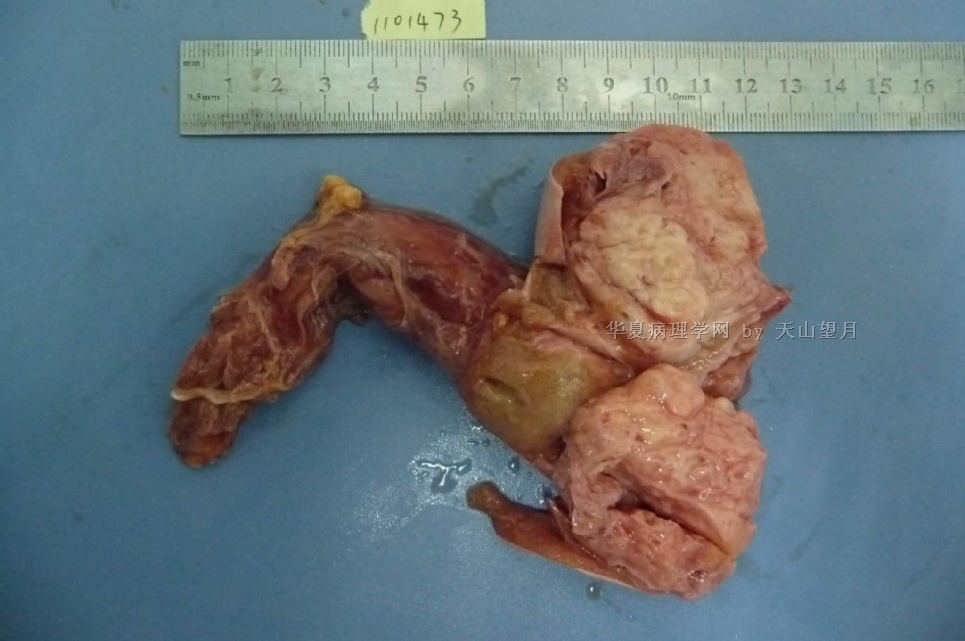 睾丸癌 早期图片