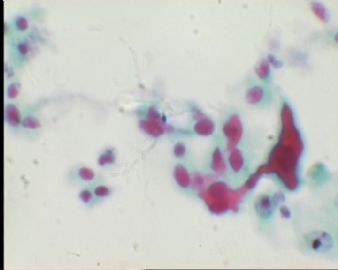 TCT1436请教（病人终于见面啦，她在外院已诊断：癌，并做了全切手术，好再没有转移。图13