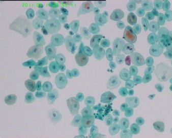 萎缩反应性改变（宫颈TCT）？图3
