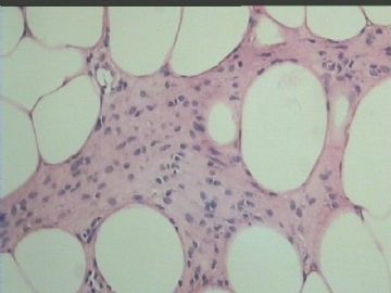 是否可以考虑良性脂肪母细胞瘤图8