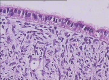 卵巢浆液性乳头状囊腺瘤 局部交界？图1