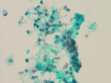 66岁，宫颈有一个熬生物，请教是否可报正常图5