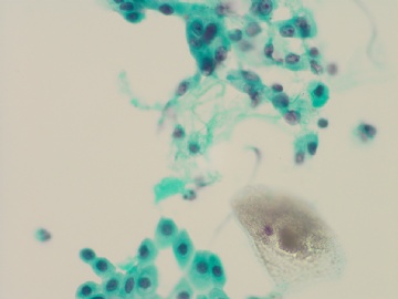 66岁，宫颈有一个熬生物，请教是否可报正常图8