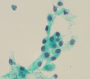 66岁，宫颈有一个熬生物，请教是否可报正常图9