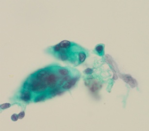 66岁，宫颈有一个熬生物，请教是否可报正常图17