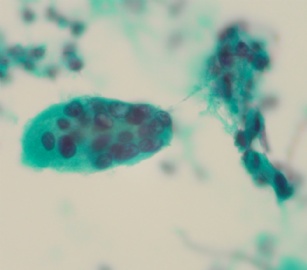 66岁，宫颈有一个熬生物，请教是否可报正常图18