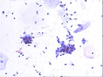 TCT：55岁。镜下：细胞呈萎缩改变，可见部分成团的小梭形细胞。图1